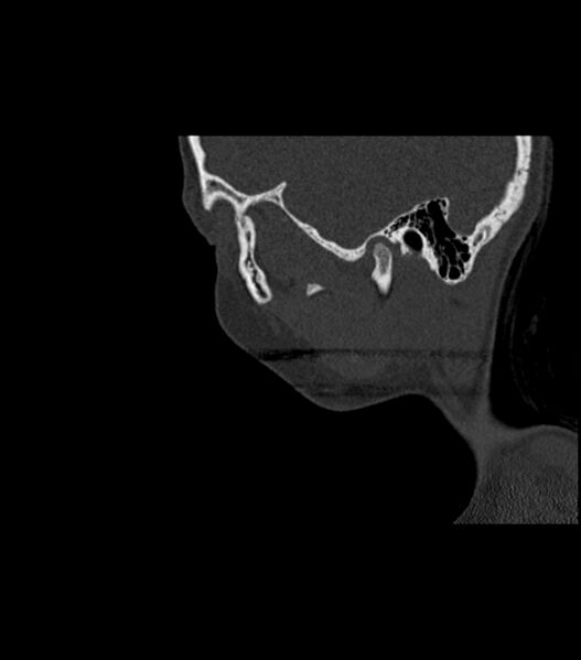 File:Nasoorbitoethmoid fracture (Radiopaedia 90044-107205 Sagittal bone window 118).jpg