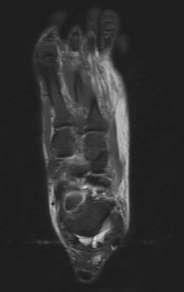 File:Navicular fracture (Radiopaedia 11662-12025 Axial 3).jpg