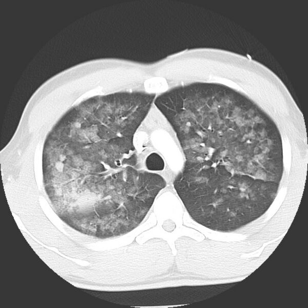 File:Near drowning pulmonary edema (Radiopaedia 16868-16591 Axial lung window 12).jpg