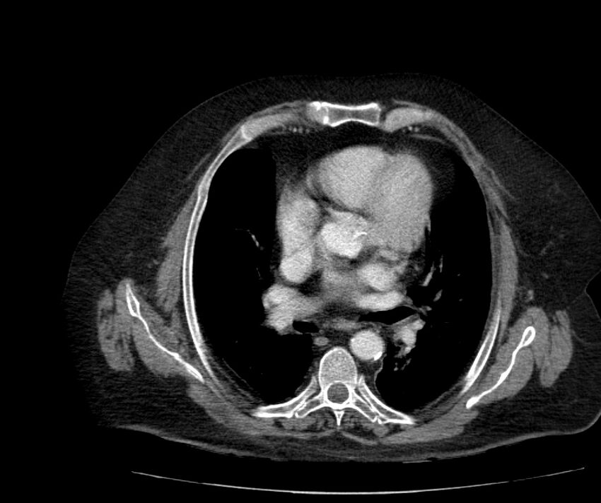 Nephroptosis with inguinal hernia containing perirenal fat (Radiopaedia 56632-63391 C 10).jpg