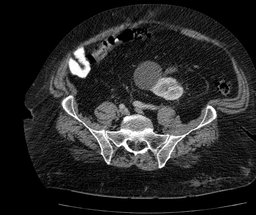 Nephroptosis with inguinal hernia containing perirenal fat (Radiopaedia 56632-63391 C 249).jpg