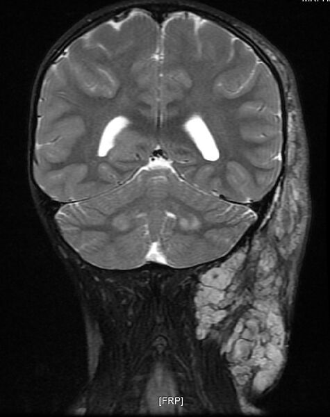 File:Neurofibromatosis type 1 (Radiopaedia 6954-8063 Coronal T2 10).jpg