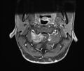 Neurofibromatosis type 1 (Radiopaedia 80355-93740 Axial T1 C+ fat sat 6).jpg