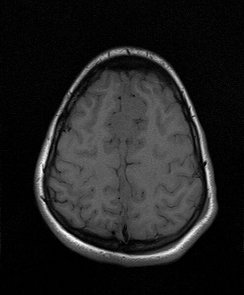 File:Neurofibromatosis type 2 (Radiopaedia 66211-75401 Axial T1 22).jpg