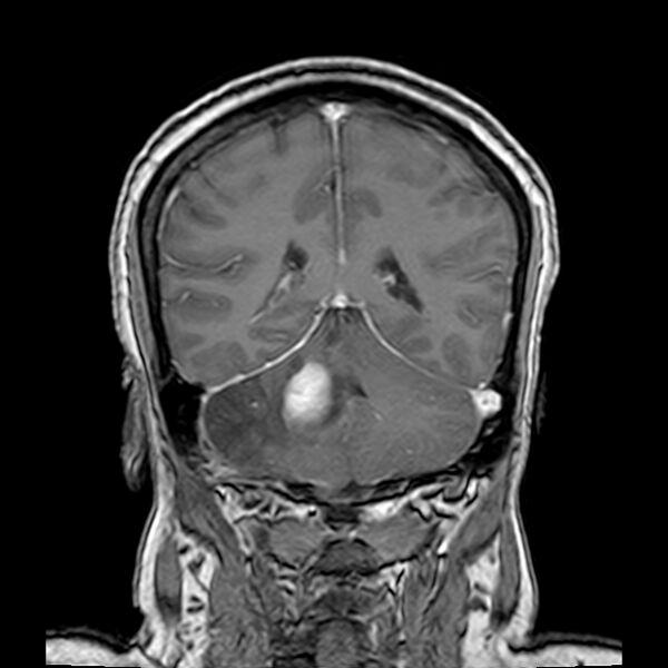 File:Neurofibromatosis type 2 (Radiopaedia 67470-76871 Coronal T1 C+ 17).jpg