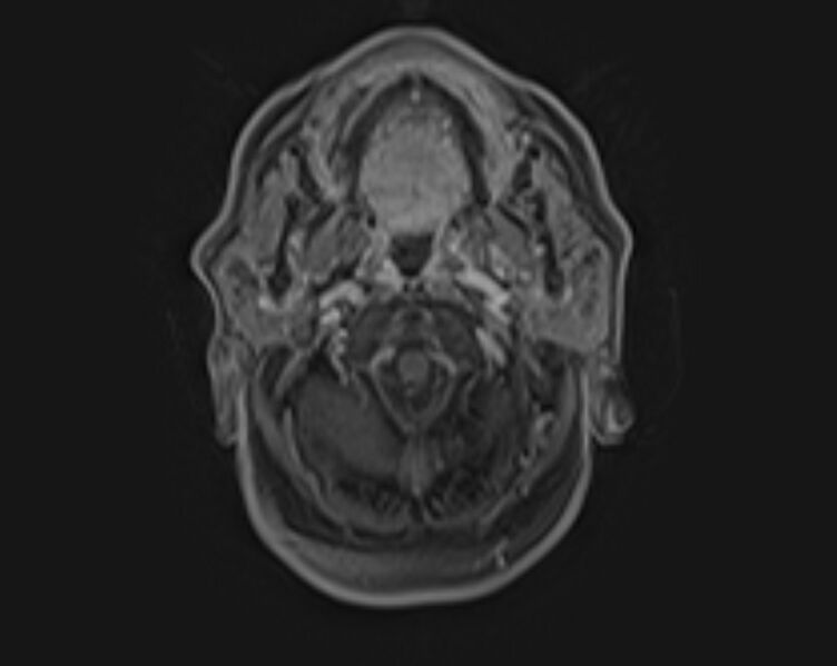 File:Non-Hodgkin lymphoma - parotid gland (Radiopaedia 71531-81890 E 41).jpg
