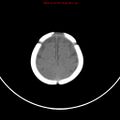 Non-accidental injury - bilateral subdural with acute blood (Radiopaedia 10236-10765 Axial non-contrast 20).jpg