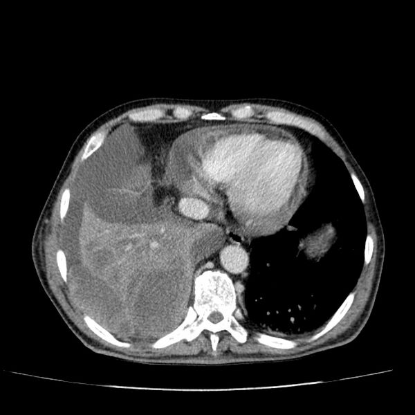 File:Non small-cell lung cancer (Radiopaedia 24467-24769 C+ delayed 48).jpg