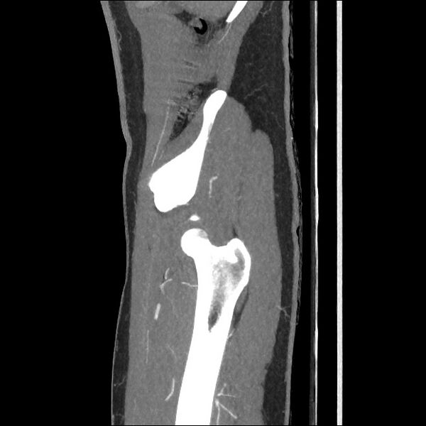 File:Normal CT angiogram of pelvis (Radiopaedia 45390-49430 C 14).jpg