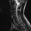 Normal cervical spine MRI (Radiopaedia 38418-40496 Sagittal T2 5).jpg