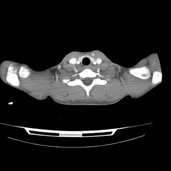 File:Normal dual-phase trauma CT chest,abdomen and pelvis (Radiopaedia 48092-52899 A 2).jpg