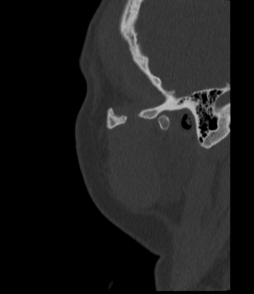Normal facial bone CT (Radiopaedia 88742-105476 Sagittal bone window 147).jpg
