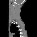 Normal trauma spine imaging (age 16) (Radiopaedia 45335-49358 C 4).jpg