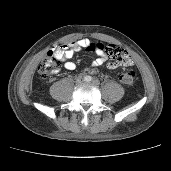 File:Obstructive bladder transitional cell carcinoma (Radiopaedia 9825-10410 A 18).jpg