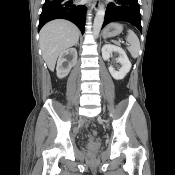 File:Obstructive bladder transitional cell carcinoma (Radiopaedia 9825-10410 B 17).jpg