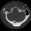 Occipital condyle fracture (Radiopaedia 18366-18208 Axial bone window 10).jpg