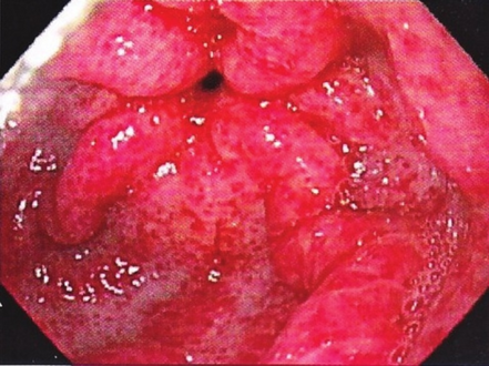 Gastric antral vascular ectasia-endoscopy