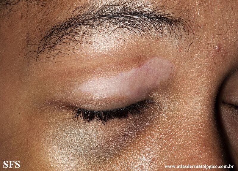 File:Vitiligo (Dermatology Atlas 59).jpg