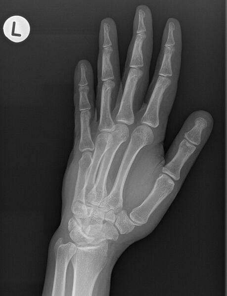 File:5th carpometacarpal joint dislocation (Radiopaedia 34851-36306 Oblique 1).jpg