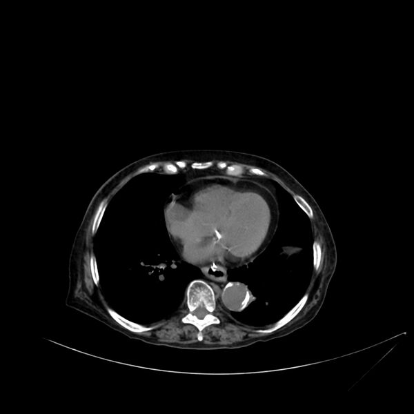 File:Abdominal aortic aneurysm - impending rupture (Radiopaedia 19233-19246 Axial non-contrast 10).jpg