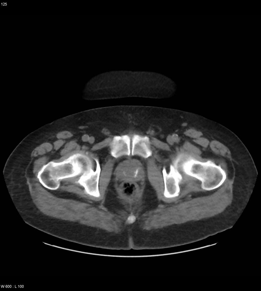Abdominal aortic aneurysm with intramural hematoma then rupture (Radiopaedia 50278-55631 Axial non-contrast 121).jpg
