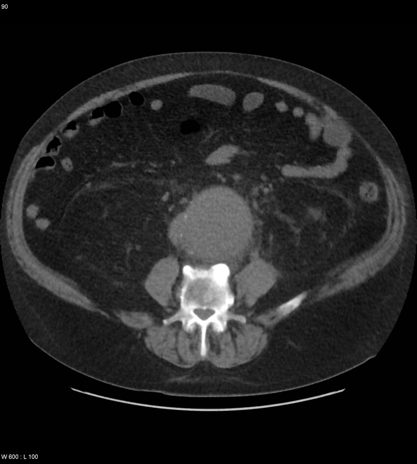 Abdominal aortic aneurysm with intramural hematoma then rupture (Radiopaedia 50278-55631 Axial non-contrast 86).jpg