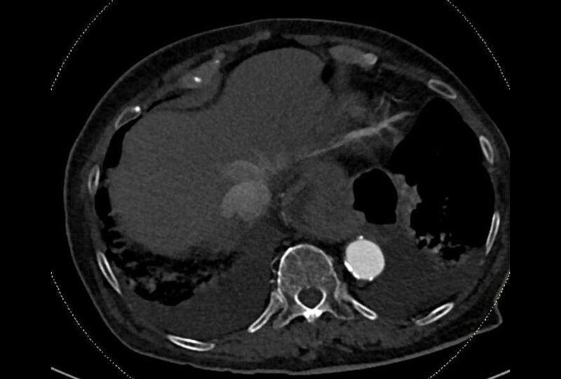 File:Abdominal aortic aneurysm with thrombus fissuration (Radiopaedia 73192-83919 Axial C+ arterial phase 2).jpg