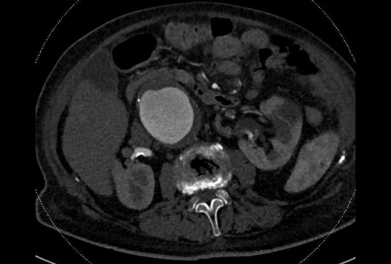 File:Abdominal aortic aneurysm with thrombus fissuration (Radiopaedia 73192-83919 Axial C+ arterial phase 68).jpg