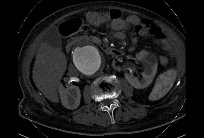 Abdominal aortic aneurysm with thrombus fissuration (Radiopaedia 73192-83919 Axial C+ arterial phase 68).jpg