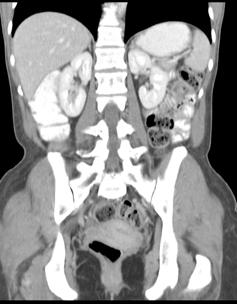 File:Abdominal desmoid tumor (Radiopaedia 41007-43740 Coronal C+ portal venous phase 27).png