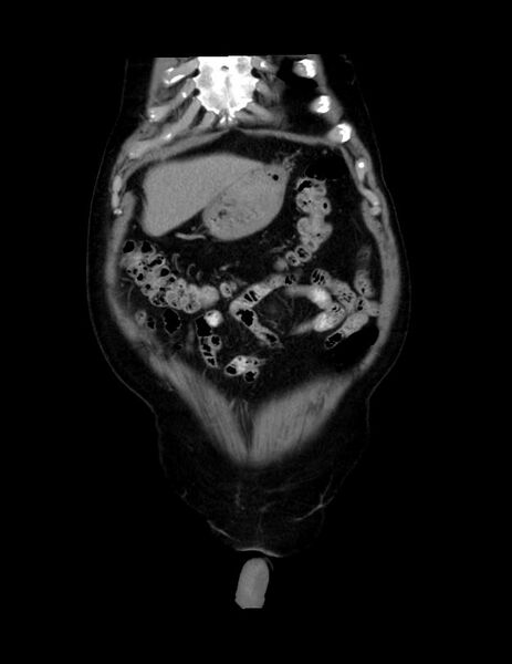 File:Abdominal lymphoma - with sandwich sign (Radiopaedia 53486-59492 C+ portal venous phase 50).jpg