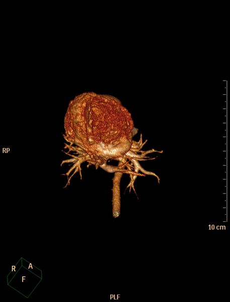 File:Aberrant left pulmonary artery (pulmonary sling) (Radiopaedia 42323-45435 3D reconstruction C+ CTPA 6).jpg