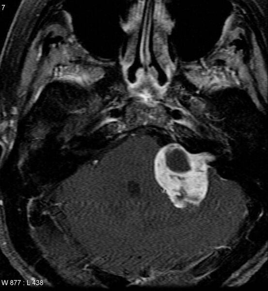 File:Acoustic schwannoma (large with cystic change) (Radiopaedia 5369-7130 Axial T1 C+ fat sat 5).jpg