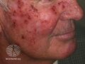 Actinic Keratoses treated with imiquimod (DermNet NZ lesions-ak-imiquimod-3733).jpg