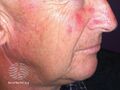 Actinic Keratoses treated with imiquimod (DermNet NZ lesions-ak-imiquimod-3750).jpg