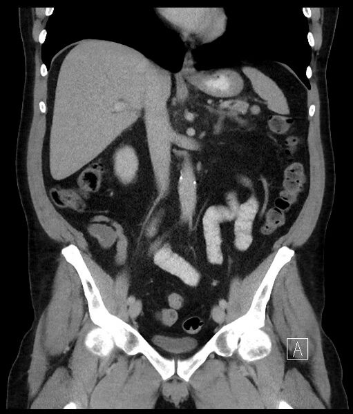 File:Acute-on-chronic pancreatitis (Radiopaedia 67286-76656 Coronal C+ portal venous phase 41).jpg