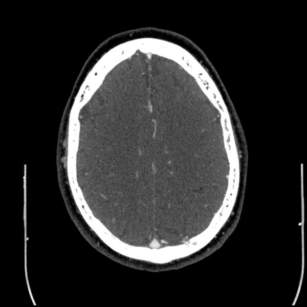 File:Acute A3 occlusion with ACA ischemic penumbra (CT perfusion) (Radiopaedia 72036-82527 Axial C+ arterial phase thins 8).jpg