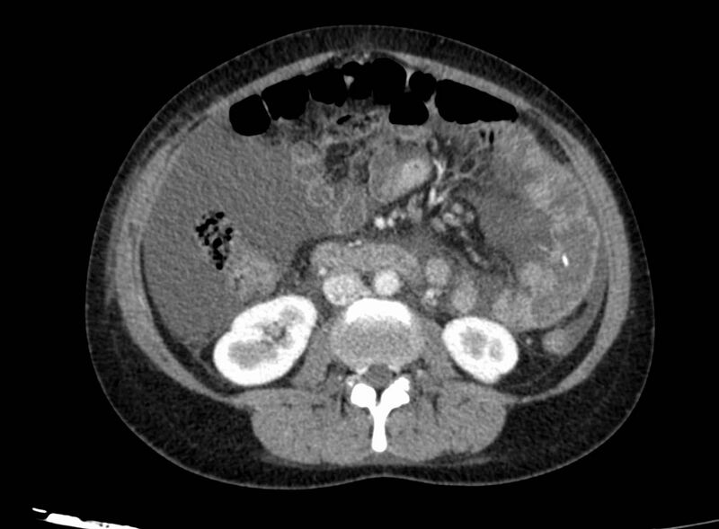File:Acute Budd-Chiari syndrome (Radiopaedia 60858-68638 Axial C+ portal venous phase 152).jpg