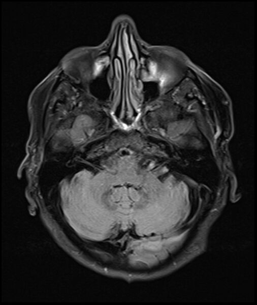 File:Acute P1 occlusion with PCA ischemia penumbra (CT perfusion) (Radiopaedia 72084-82590 Axial FLAIR 8).jpg