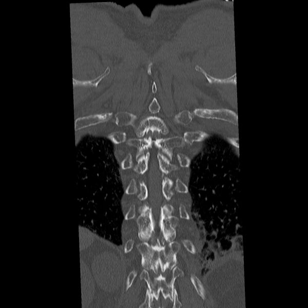 File:Acute and chronic vertebral compression fractures (Radiopaedia 31608-32494 Coronal bone window 40).jpg