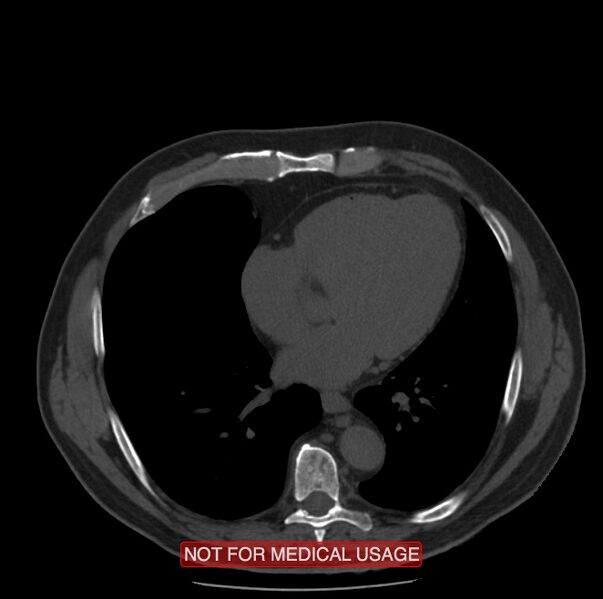 File:Acute aortic dissection - Stanford type A (Radiopaedia 40661-43285 Axial non-contrast 42).jpg