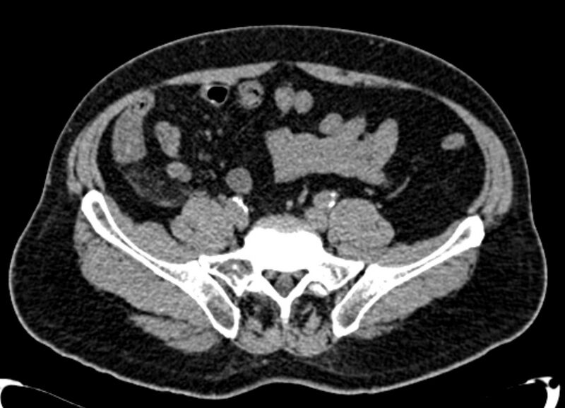 File:Acute appendicitis (Radiopaedia 13030-13091 Axial non-contrast 23).jpg