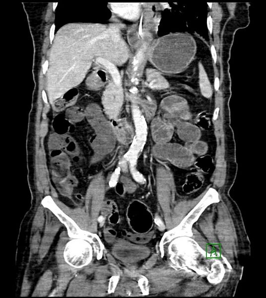File:Acute arterial mesenteric ischemia (Radiopaedia 78238-90828 Coronal C+ portal venous phase 50).jpg