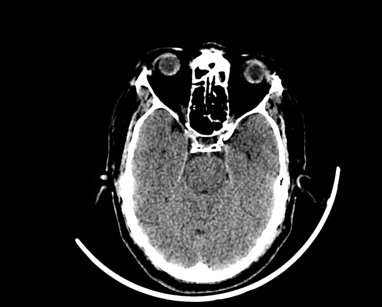 File:Acute cerebral infarct (Radiopaedia 35604-37123 Axial non-contrast 33).jpg
