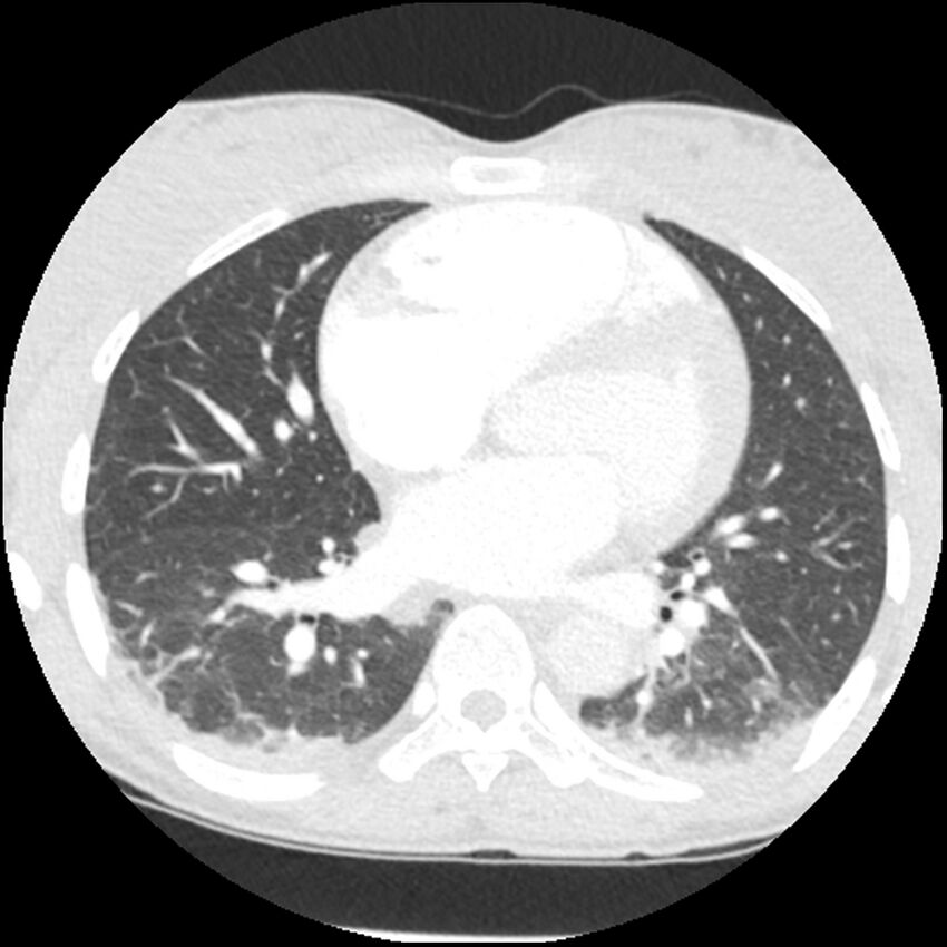 Acute chest syndrome - sickle cell disease (Radiopaedia 42375-45499 Axial lung window 111).jpg
