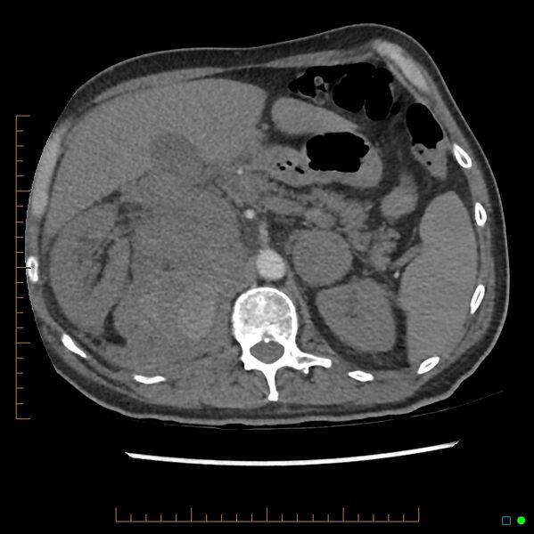 File:Acute hemorrhage into adrenal metastasis from NSCLC (Radiopaedia 43135-46429 Axial C+ CTPA 16).jpg