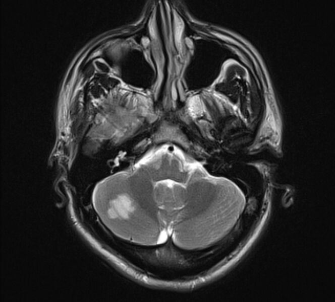 File:Acute ischemic stroke - posterior circulation territory (Radiopaedia 77670-89880 Axial T2 6).jpg