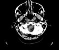 Acute left middle cerebral artery infarction (Radiopaedia 75674).jpg