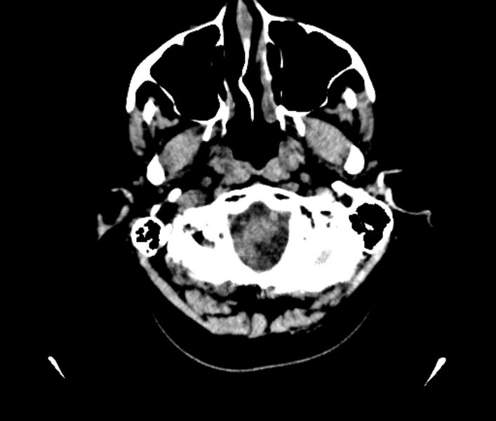 File:Acute left middle cerebral artery infarction (Radiopaedia 75674).jpg