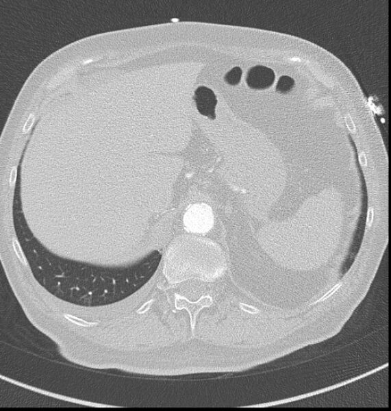 File:Acute myocardial infarction (Radiopaedia 23413-23481 lung window 69).jpg